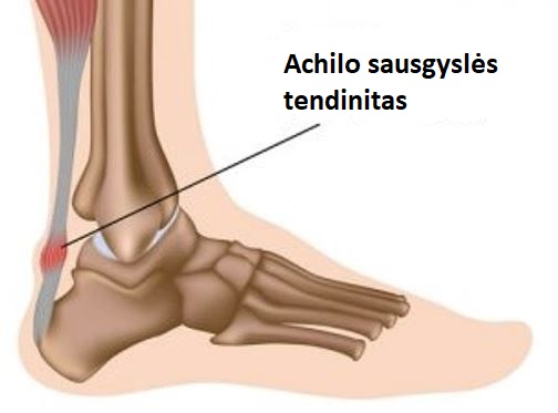 achilo sausgysles tendinitas 1