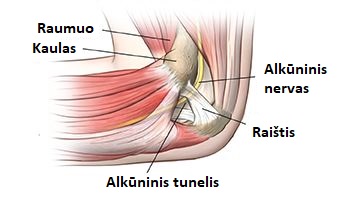alkuninis tunelinis sindromas 1