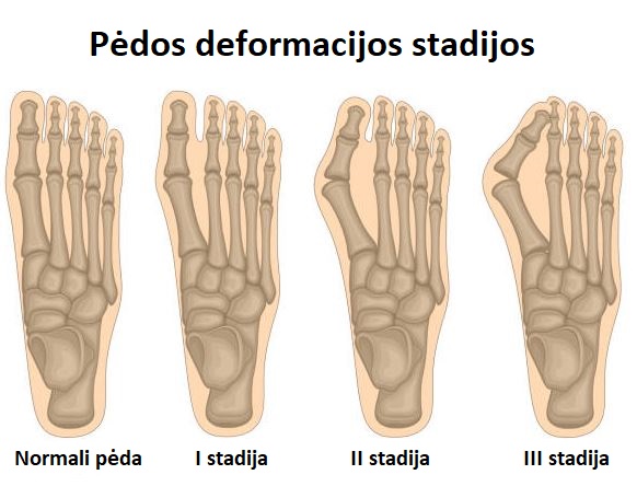 hallus valgus 1