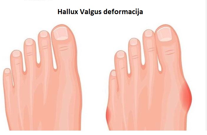 halus valgus 1