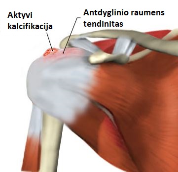 kalcifikuot tendinitas 1