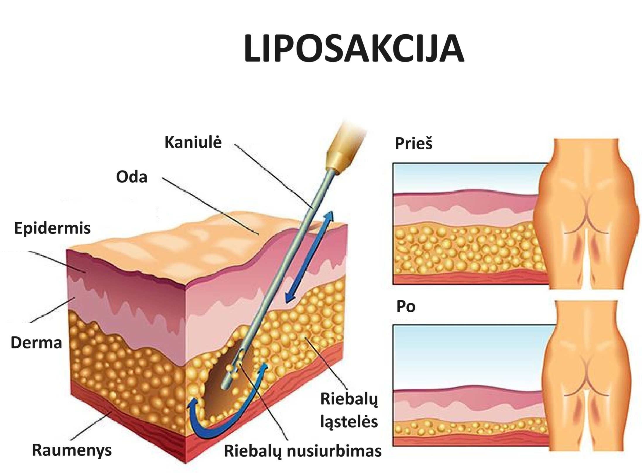 liposakcija
