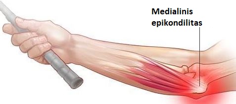 medialinis epikondilitas 1