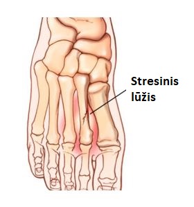 padikauliu stress luziai 1