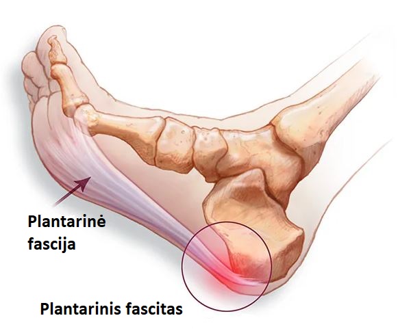 plantarine fascija 1