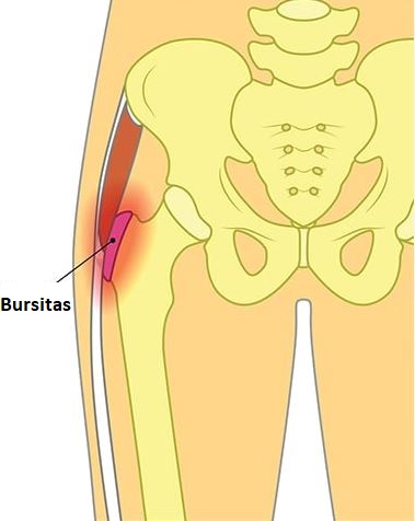 trochanteris bursitas 1