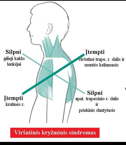 virsutinis kryzminis sindromas